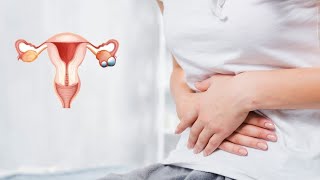 Ovarian Cysts  ओवरी में सिस्ट प्रेग्नेंसी में कितना बाधकसिस्ट होने पर प्रेग्नेंट नहीं हो सकती है [upl. by Potts]