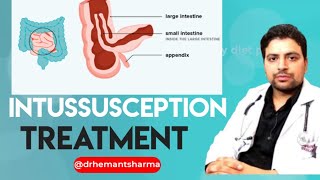 Intussusception treatment in hindi drhemantsharma treatment [upl. by Henriette877]