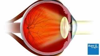 How LASIK eye surgery is carried out [upl. by Waugh771]