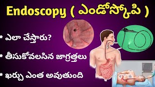 Endoscopy Test in Teluguఎండోస్కోపి ఎలా చేస్తారు ఖర్చు ఎంత అవుతుంది [upl. by Aeel]