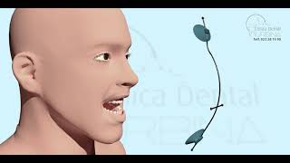 Dispositivos de Ortodoncia Disyuntor Palatino y Mascara Facial [upl. by Hooke]