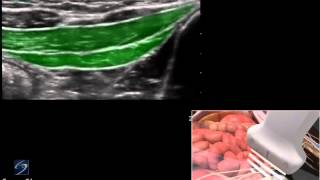 3D How To Ultrasound Guided Ilioinguinal and Iliohypogastric Nerve Block  SonoSite Ultrasound [upl. by Ortensia]