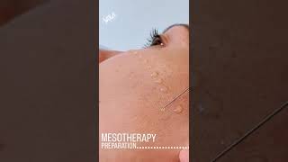 Mesotherapy Facial Treatment Benefits Procedure amp FAQ  EDEN AESTHETICS Dubai [upl. by Anelis]