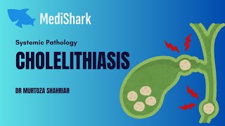 Systemic Pathology Cholelithiasis Dr Murtoza Shahriar [upl. by Tera562]