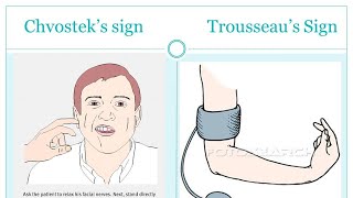 Trousseaus sign of latent tetany [upl. by Josepha]