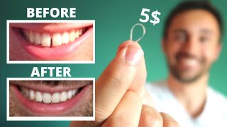 DIY CLOSE GAP TEETH AT HOME  My Update [upl. by Kurtzman]