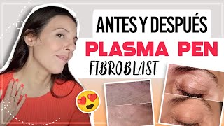 PLASMA PEN FIBROBLAST ANTES Y DESPUES  CarolinaSKB CarolinaTV plasmapen plasmafibroblast [upl. by Nylegna]