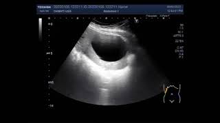 Hydatid Hepatic Cyst [upl. by Julius]