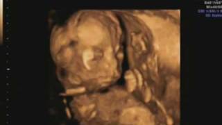 19 week ultrasound Its a girl Includes 3d4d scan [upl. by Notsek375]