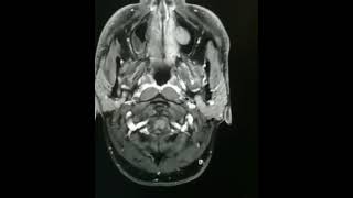 Mri post contrast Brain imaging ho Right side weaknessstudentsdiagnosis Glioma vs Astrocytoma [upl. by Melania]