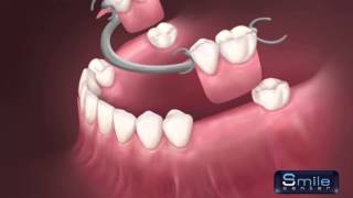 Removable denture Beirut Lebanon  Dentist Lebanon [upl. by Enrak]