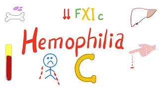 Hemophilia C Factor XI deficiency [upl. by Ailadgim561]