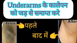 underarms के कालेपन की सबसे महत्वपूर्ण दवा।।medicine for underarm blacknessbest homeopathy [upl. by Annoya343]