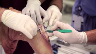 Patellar Tendon Graft [upl. by Eda]