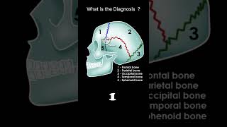 Skull bones and sutures  lateral viewCT Brain Anatomy Skull bones Quiz 3radiologychannel007 [upl. by Harifaz162]