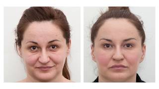 The results of dermal fillers before and after [upl. by Nehtiek947]