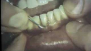 Scaling and Root Planing Part II Mandibular Teeth [upl. by Adnauqal423]