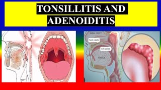 TONSILLITIS AND ADENOIDITIS  Define etiology pathophysiology  clinical  management  MSN [upl. by Annairol880]