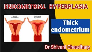 Endometrial hyperplasia  Thick endometrium heavybleeding uterus [upl. by Ihcur]