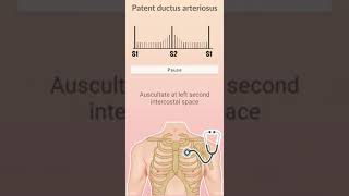 patent ductus arterioususPDA and auscultation of heart sound and heart murmur [upl. by Zoes]