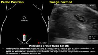 Step By Step Guide On 7 Week Pregnancy Transabdominal Ultrasound Scan  Full Protocol With Reporting [upl. by Bonny]