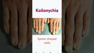 Koilonychia by Mamta Mam exam homescience education food motivation viralvideo viralshorts [upl. by Erick]