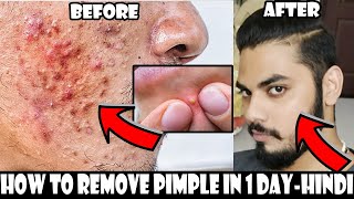 How To Get Rid of a Pimple In One Day  Homemade Pimple amp Acne Treatment  Asad Ansari [upl. by Olin]