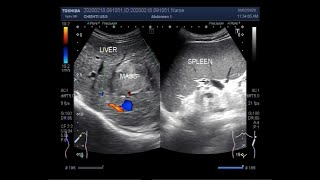 Video showing two cases one showing a Large Hepatic cyst and another a large hepatic mass [upl. by Herrod]