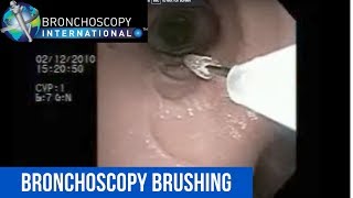 Flexible Bronchoscopy Basic Techniques 5  Brushing [upl. by Liu]