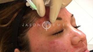 THICKEN YOUR EYEBROWS AND STOP THINNING WITH PRP AND HORMONES FOR HAIR RESTORATION  DR JASON EMER [upl. by Drus967]