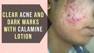 CALAMINE lotion  Lacto calamine lotion uses in detail side effects [upl. by Waneta]