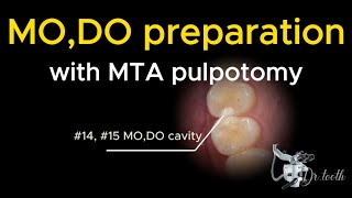 MO DO inlay preparation with MTA pulpotomy under microscope [upl. by Nij]