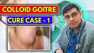 Colloid Goitre CURE Case No 1  Homeopathy Treatment for Colloid Goitre  Dr Abhik Ghosh [upl. by Enenaej]