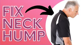 How You Can Get Rid of Neck Hump With a SOCK Dowagers Hump [upl. by Enerod]