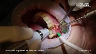 PIEZOSURGERY  Dr Constantin von See  Ultrasonic periosteal dissection [upl. by Htir]