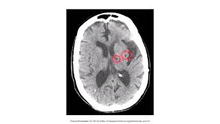 Cerebrovascular Disease for the USMLE Step 1 [upl. by Ial]