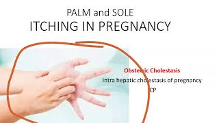 Obstetrics Cholestasis Pregnancy IntraHepatic Liver ICP Itching Palm pregnant Bile Acid Ursodiol [upl. by Nonnaihr]