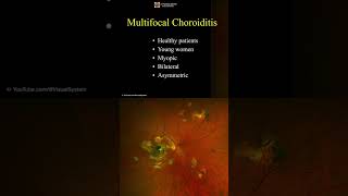 Multifocal Choroiditis ophthalmology optometry [upl. by Nicholas46]