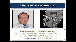 EPENDYMOMA RADIOLOGY [upl. by Anitnatsnok]