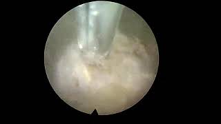 Endoscopic Rhizotomy  Dr Kevin P McCarthy [upl. by Womack638]