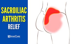 How to Instantly Relieve Arthritic Sacroiliac Joint Pain [upl. by Randolf653]