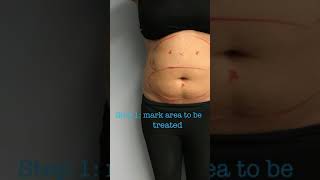 Full CoolSculpting Treatment with Before and Afters [upl. by Nieberg]