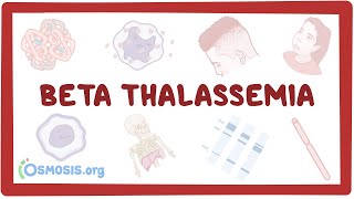 Betathalassemia  causes symptoms diagnosis treatment pathology [upl. by Oirromed]