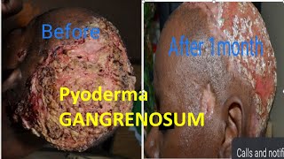 PYODERMA GANGRENOSUM PG BY DR ABRAHAM education funny letushelpyouglowinyourownbeautifulskin [upl. by Leakcim]