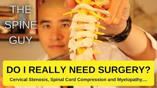 Cervical Stenosis Spinal Cord Compression and Myelopathy DO I REALLY NEED SURGERY [upl. by Ahsino757]