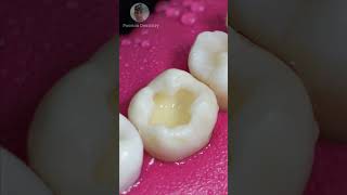 Repairing Dental Caries toothrestoration shorts [upl. by Wycoff]