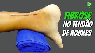 Como acontece a fibrose no tendão de Aquiles após a cirurgia  FISIO EM MOVIMENTO [upl. by Ennaoj567]