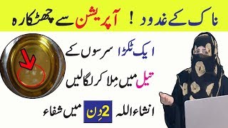 Causes  Symptoms Treatment of Nasal polyps in Urdu  Anam Home Remedy [upl. by Close886]