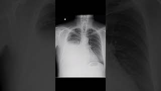 Right hydropneumothorax [upl. by Yriek]