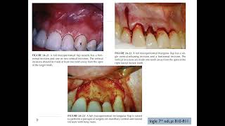 Endodontic Surgery periapicalsurgery endodontics loveendo lovedentistry [upl. by Jilleen]